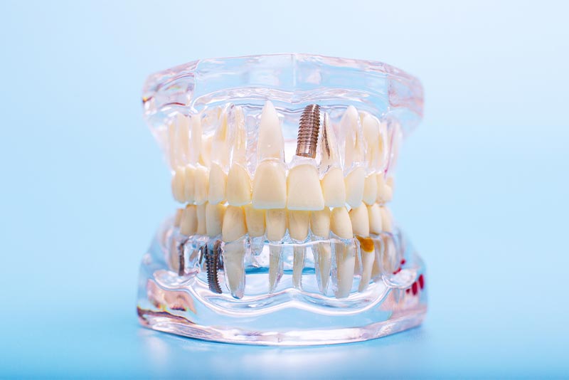 インプラント治療とは