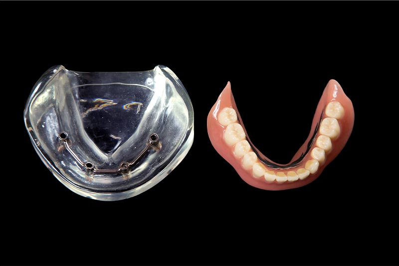 インプラントオーバーデンチャーにも対応