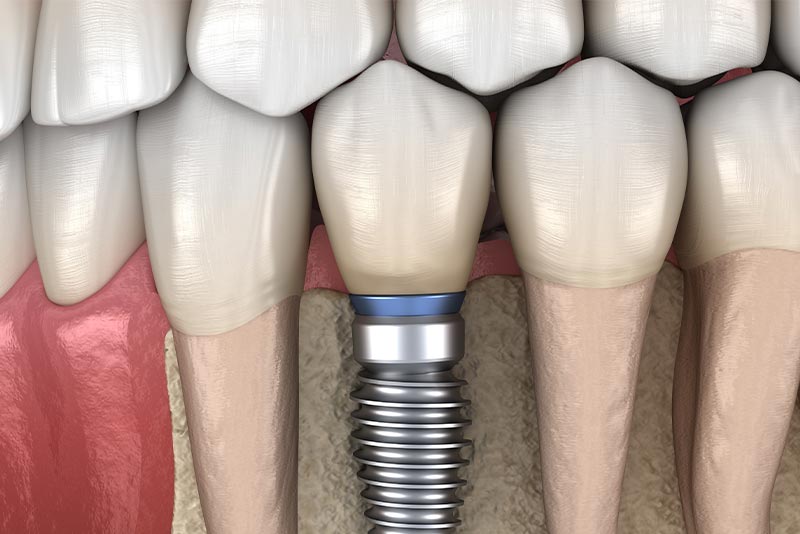 上部構造（人工歯） の装着